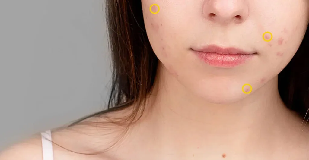 Close-up of adult facial acne on the cheeks and chin