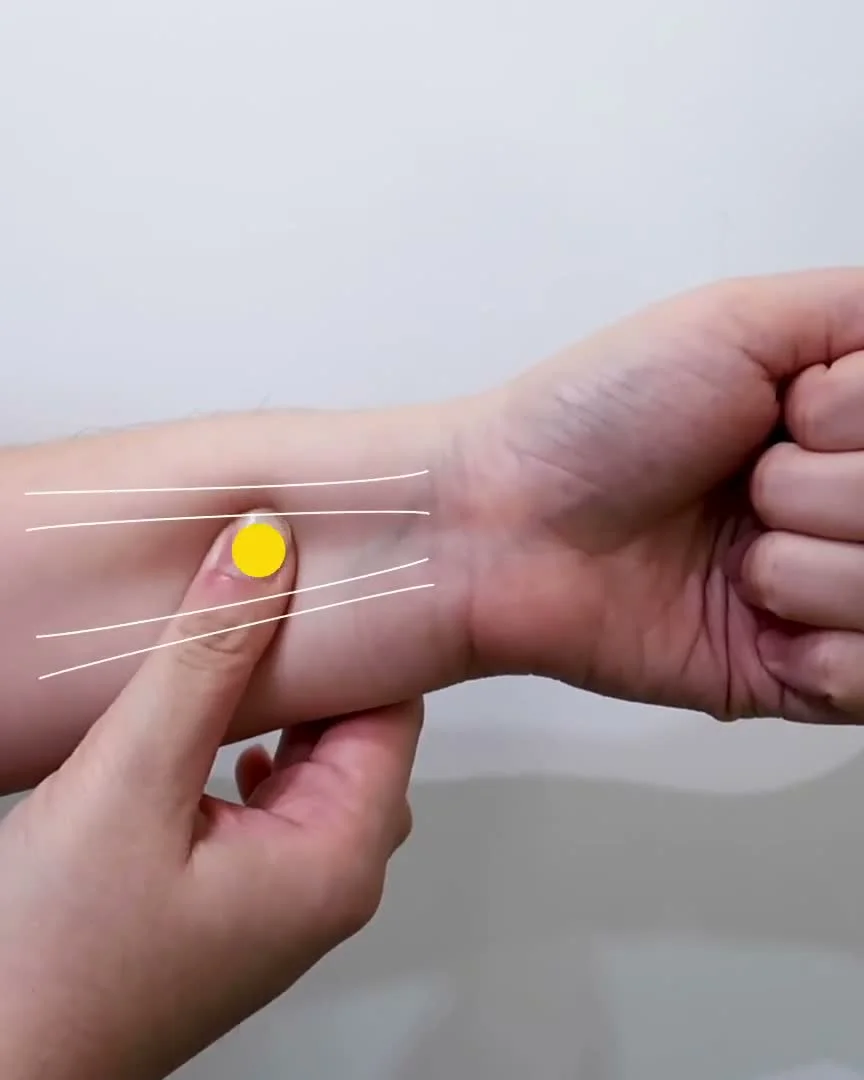 Thumb pressing Nei Guan PC6 between two tendons marked on the inner forearm