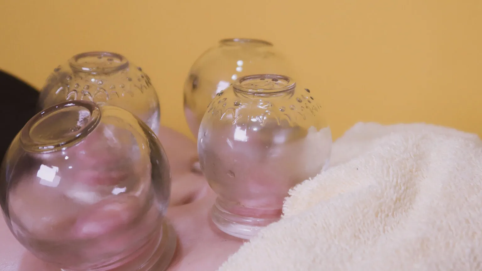 Cupping cups and clinic setup prepared for treatment