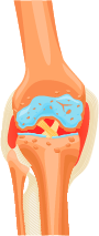 Worn knee cartilage and joint inflammation in arthritis