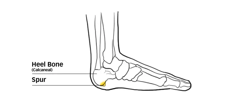 Diagram of a heel bone spur on the underside of the heel