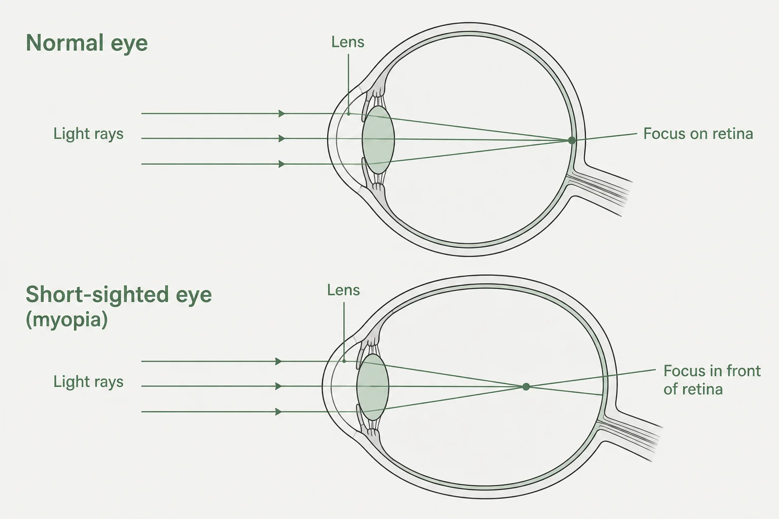 Diagram comparing normal eye focus on the retina with myopic focus in front of the retina