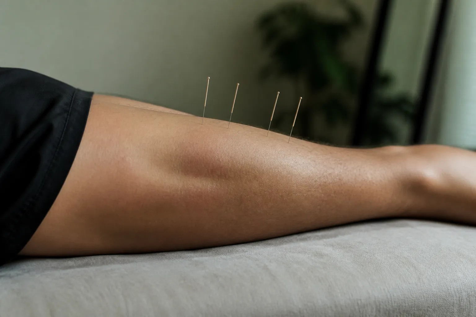 Acupuncture needles in an athlete’s calf for DOMS recovery after training