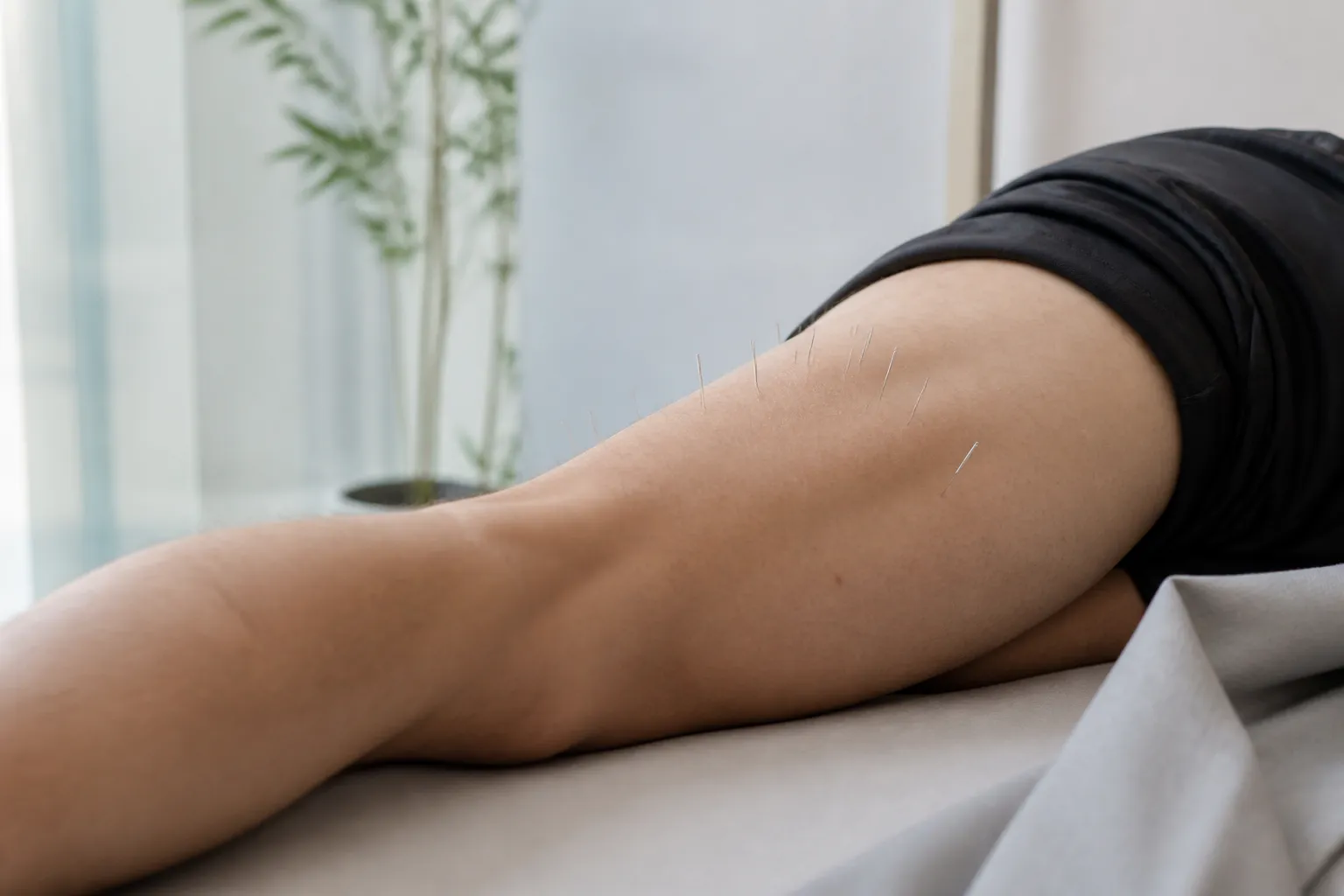 Acupuncture needles on an athlete’s quadriceps for sports performance support