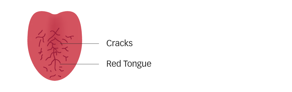 Diagram of a red cracked tongue with little coating for Yin deficiency