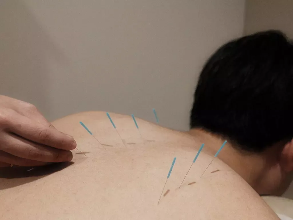 Physician placing acupuncture needles along the upper back at PULSE TCM