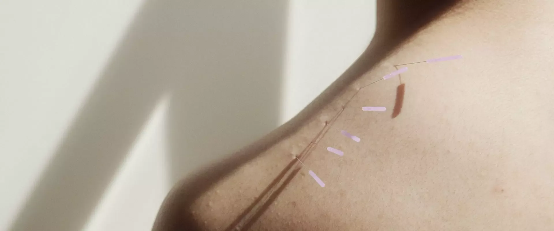 Fine acupuncture needles placed in the shoulder for treatment at PULSE TCM