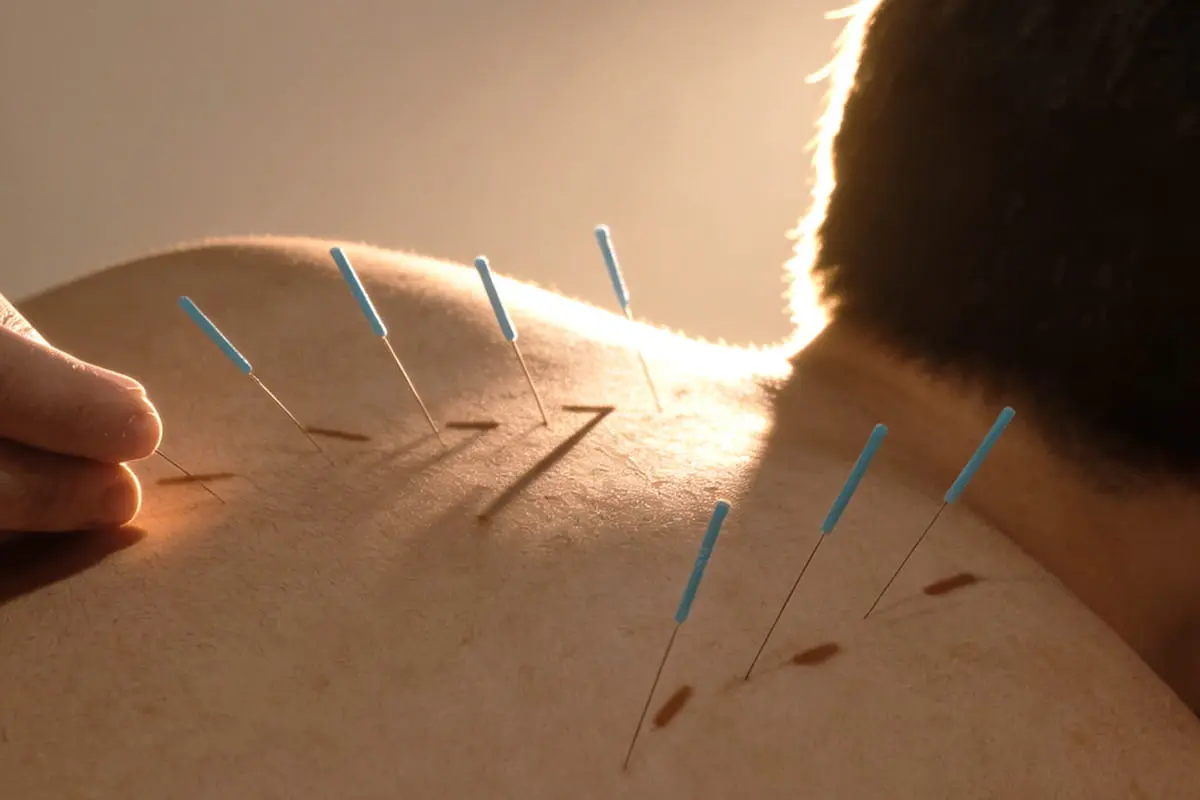 Clinical acupuncture for anxiety at PULSE TCM
