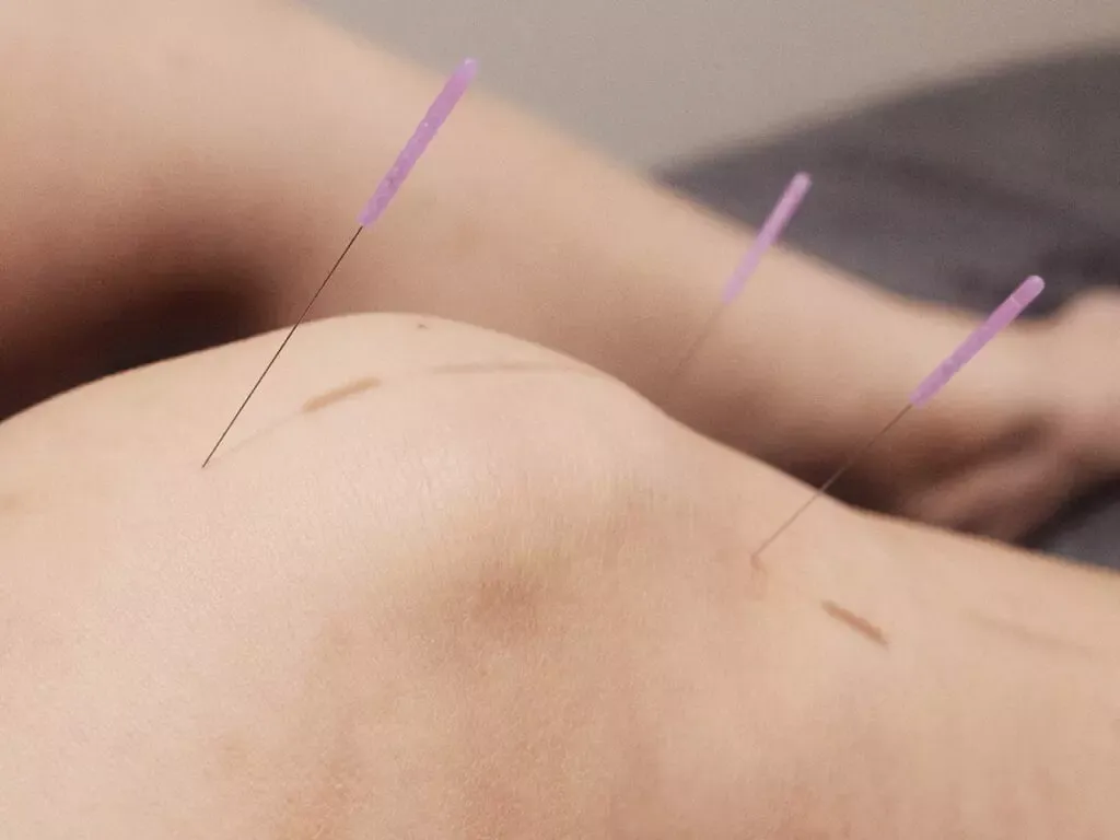 Acupuncture needles on the leg during treatment at PULSE TCM