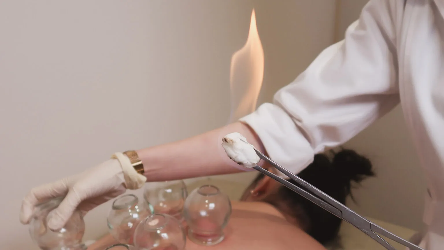 Cupping therapy treatment at a PULSE TCM clinic