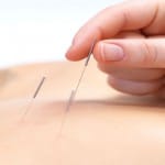 acupuncture treatment