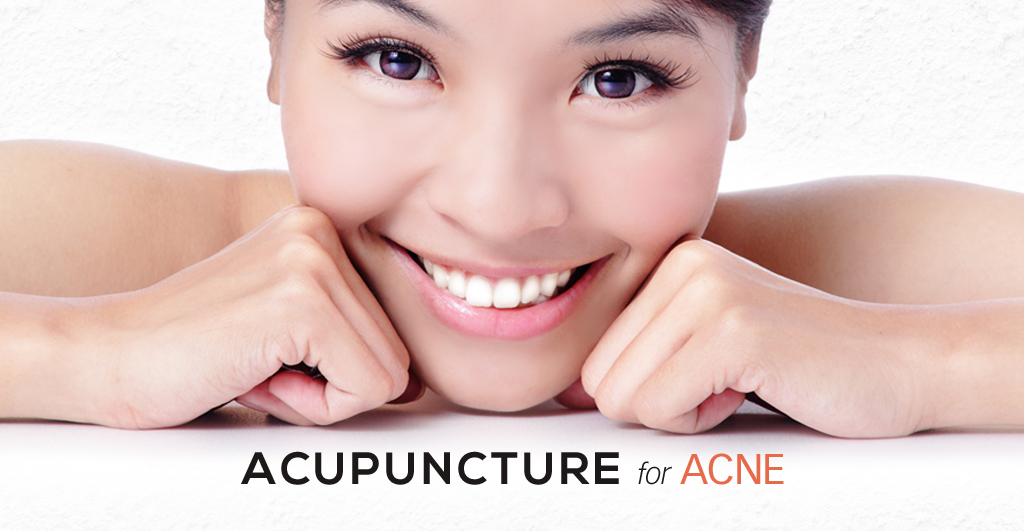 Acupuncture for Acne - PULSE TCM Clinic Singapore