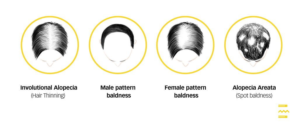 types of hair loss pulse tcm clinic