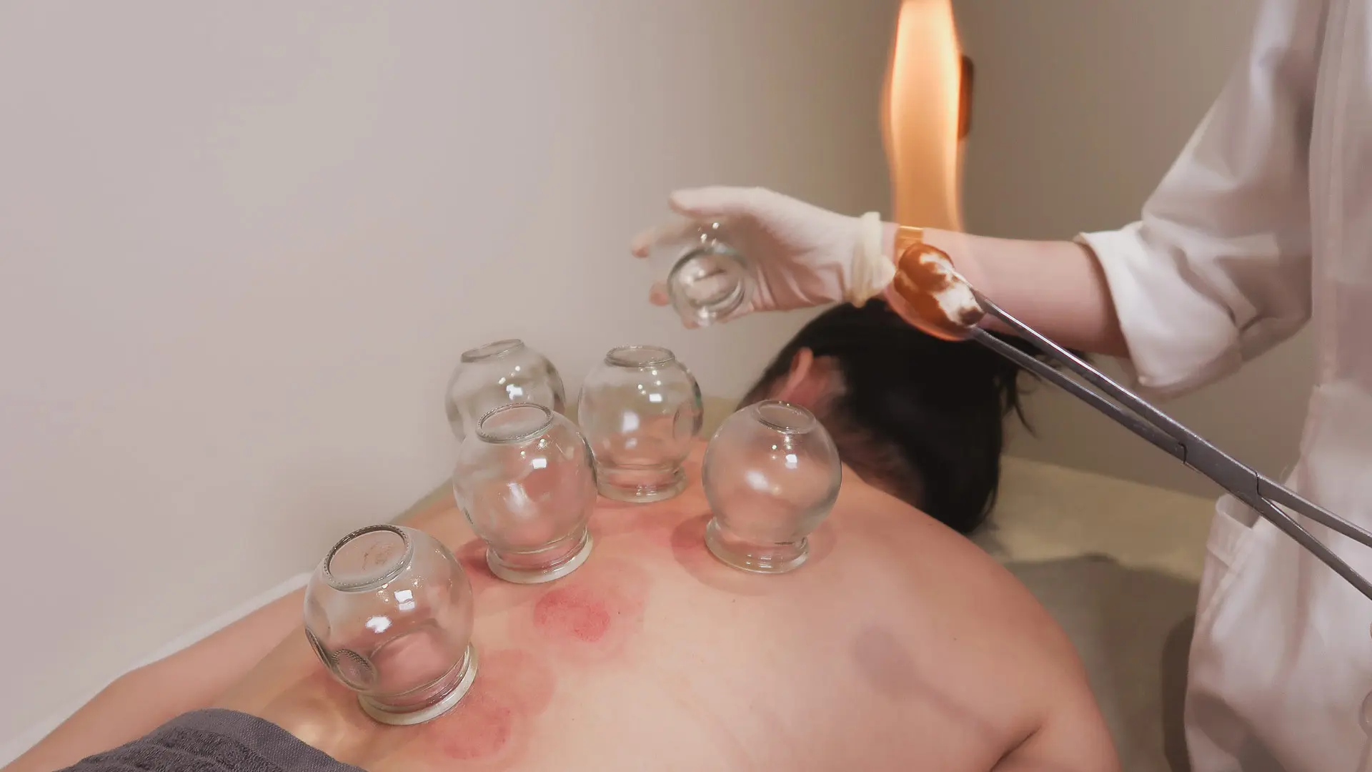 Cupping with live fire