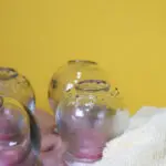 cupping therapy